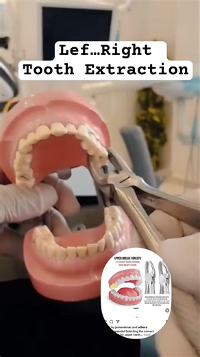 Left .. Right 🦷tooth extraction movement upper Molar