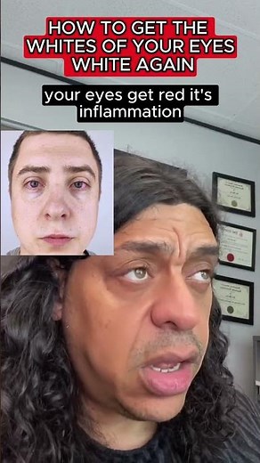 ✅HOW TO GET YOUR EYE WHITES BETTER✅