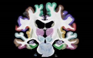 New brain atlas offers unprecedented detail in MRI scans
