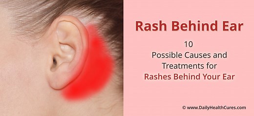 Rash behind Ear: 10 Possible Causes and Natural Treatments