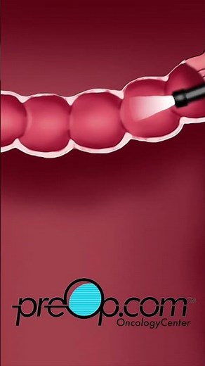 PreOp® Colonoscopy Explained | Prep, Procedure, and Recovery