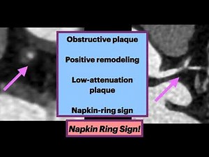 Napkin Ring Sign Radiology #Radiology #Cardiovascular #Cardiology