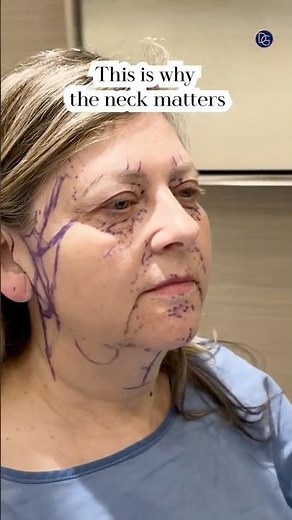 Neck Lift Natural Results| Before and After| Dr. Daniel Gould #beverlyhillsplasticsurgery