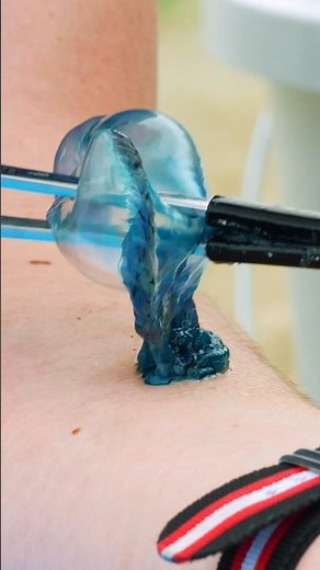 Stung by a Man O War! (Jellyfish)