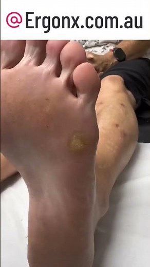 Ultimate Corn & Callus Removal by Aussie Podiatrist #FootCare #Australia