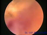 Transcervical Resction Of Fibroid • Video • MEDtube.net