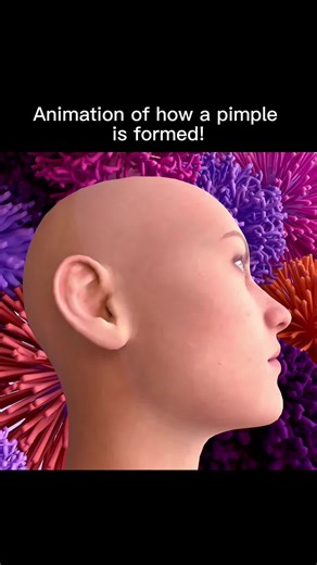 Ever wondered how pimples come to life? 🤔🔍 Join us for a fascinating animated journey into the world of pimple formation! 🧡 #annimation #science #explained #acne #acnetretatment #dermatologist #pimple #satisfying