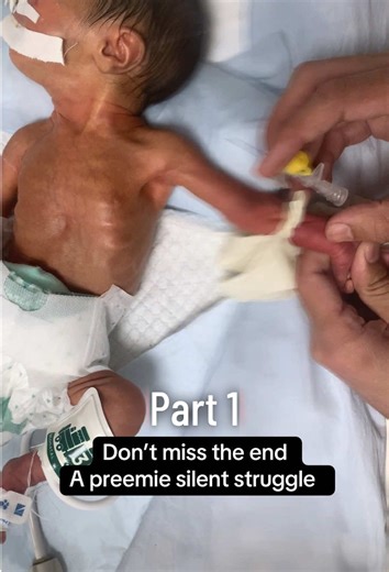 IV canula insertion ỉn premature baby (part 1)#seriouscondition #cutebaby #NewbornCare #baby #NICU