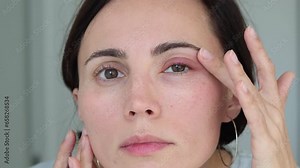 Close up female patient's infected eye. The brown-eyed woman staring at the camera has an external stye bacterial infection. Hordeolum on upper eyelid. Viral Infection. Staphylococcus. Ophthalmology