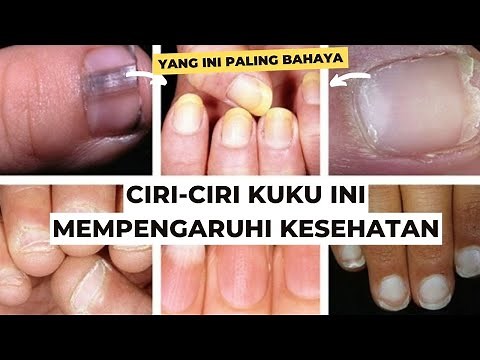 Kondisi Kuku Seperti Ini, Bisa Jadi Tanda Penyakit!