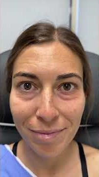 Lower lid blepharoplasty, fat repositioning, and chemical peel - 20 days post op