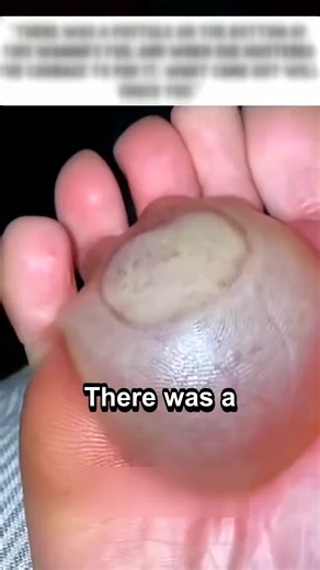 Shocking Foot Pustule Story: What Came Out Will Astound You
