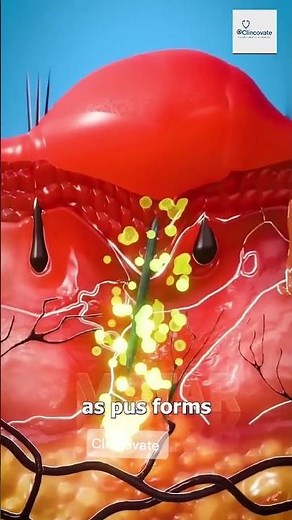 "What REALLY Happens When You Get a Splinter!" !📌