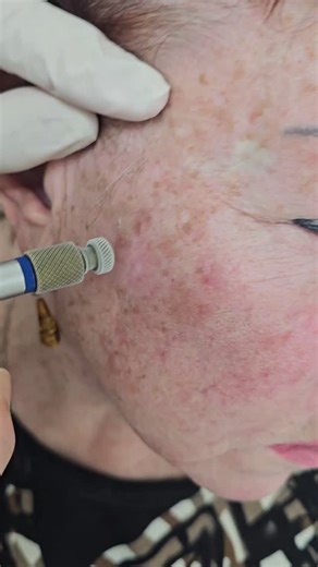 Dr. Olga Goulko's Cryosurgery of seborreic keratosis⁣⁣⁣ ⁣ 📍Anesthesia - local numbing cream⁣⁣⁣⁣ ⏰Treatment time - 5-10 sec.⁣⁣⁣ ⁣⁣⁣⁣ Dermatology & Laser Surgery ⁣⁣⁣⁣⁣⁣⁣⁣⁣⁣⁣⁣⁣⁣✉-info@lasersurgery.net⁣⁣⁣⁣⁣⁣⁣⁣⁣⁣⁣⁣⁣⁣ 🖥- www.lasersurgery.net⁣⁣⁣⁣⁣⁣⁣⁣⁣⁣⁣⁣⁣⁣ 🏢- 2125 Center Ave⁣⁣⁣⁣⁣⁣⁣⁣⁣, Fort Lee, NJ⁣⁣⁣⁣⁣ ☎- 201-461-5655⁣⁣⁣⁣⁣⁣⁣⁣⁣⁣⁣⁣⁣⁣ ⁣⁣⁣⁣⁣⁣⁣⁣⁣⁣ ⁣⁣⁣⁣⁣⁣⁣#cryosurgery #skincancer #seborrheickeratosis #sundamage #skincancer #fortleenj #drolgagoulko #mdskinline | Dermatology & Laser Surgery Center