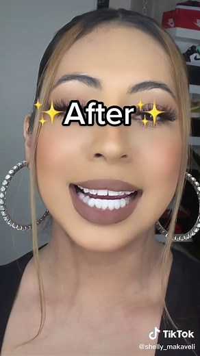 Porcelain crowns✨ Best decision I ever made! I’m in love 😻