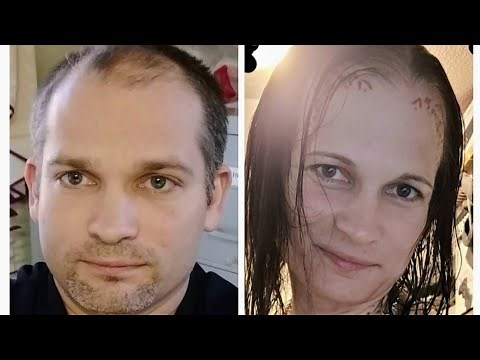 Transgender Transition Timeline Slideshow 3 years of HRT for MTF