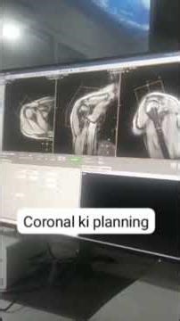 Mri Shoulder ki planning कैसे करते है #radiology #doctor #anisqureshi #tech #anatomy #viral