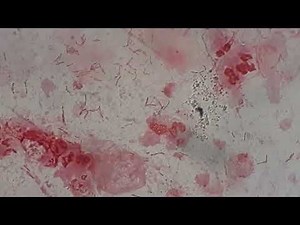 Numerous Gram negative rods in Gram staining of sputum