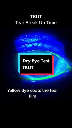 Understanding Tear Breakup Time for Dry Eyes