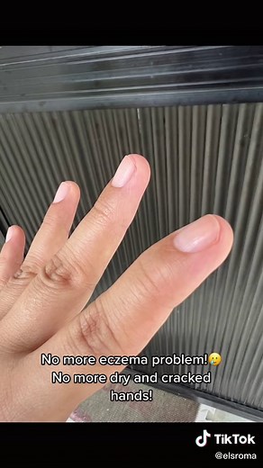 Hand Cream for Eczema Relief | Veiny Hands Compilation