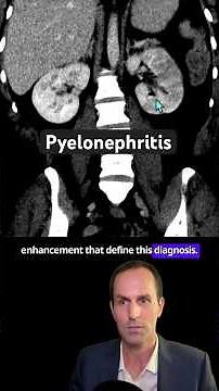 Abdominal CT Tutorials - Pyelonephritis