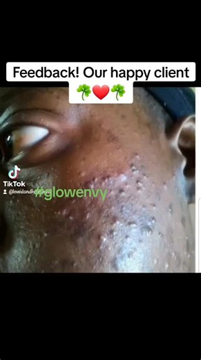Our Acne and Scrubs Combo.... Glowing clear skin is ALWAYS in....❤☘❤☘