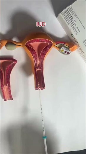 About the IUD (birth control)