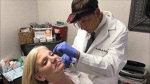 Bellafill injection with microcannula technique