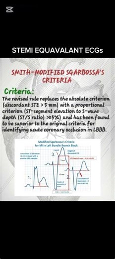 STEMI EQUAVALANT ECGs #ecg #shorts #medical #shortvideo #medicalstudent