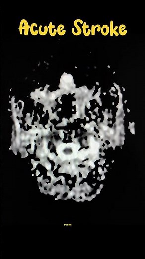 Acute Stroke MRI DWI ADC Sequence #dwistroke #mri #brain