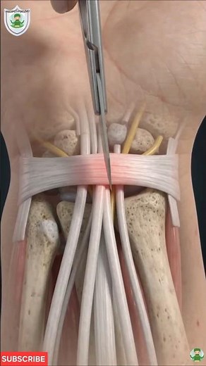 How Do Surgeons Fix Carpal Tunnel Syndrome