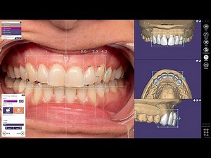 exocad DentalCAD 2.3 Matera with Smile Creator add-on module