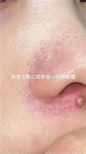 私のニキビ肌の歴史