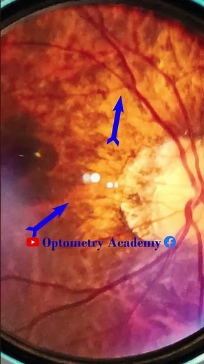 Tigroid Fundus | Smartphone Fundus Videography | Fundus Photography | Short Video 477