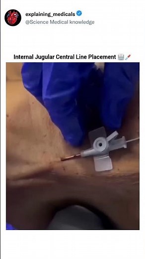 Internal Jugular Central Line Placement Explained Step-by-Step 🏥 | ICU Skills”