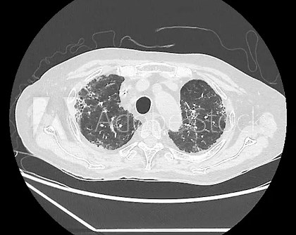 CT Chest Showing Interstitial Lung Disease with Fibrotic NSIP Pattern and Bilateral Ground-Glass Opacities