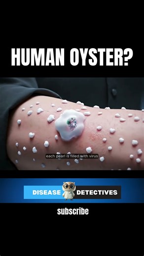 What If Your Grew Pearls? | "Pearl Disease Explained #diseases