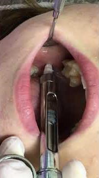 Mandibular block (Мандибулярная анестезия)