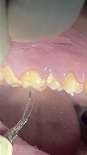 Teeth Scaling tartar & calculus #dentist