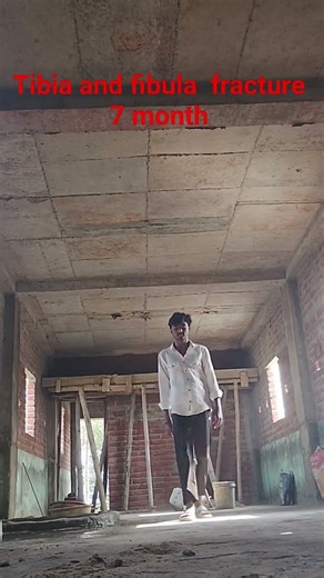 tibia and fibula fracture 7 month