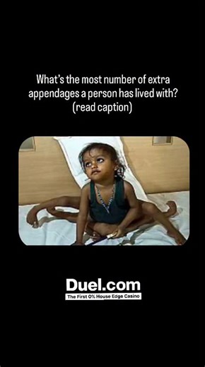 @miyozakhi on Instagram: "This is Lakshmi Tatma, a little girl with big brown eyes and eight limbs. Her parents named her Lakshmi, after the four-armed goddess of fertility and prosperity, on whose festival she was born. But her family was poor, and they couldn’t afford surgery for her, so they took her home to care for her as best they could. When some circus people tried to buy Lakshmi as a sideshow exhibit, her parents had to take her into hiding. Developmentally, Lakshmi started out as a set