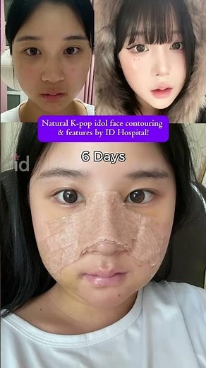 Korea Plastic Surgery Transformation: Contour, Nose & Lifting | Natural Results