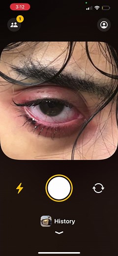 Close-Up of Swollen Eye: Understanding Eye Injuries