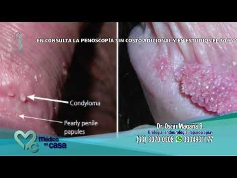 Infección de virus de papiloma humano en hombres (VPH)
