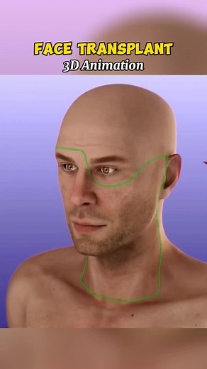 Face Transplant - the complex surgery involving 30 doctors will last about 16 hours #medical #learnontiktok