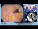 ERCP and Bile Duct Stone Extraction • Video • MEDtube.net