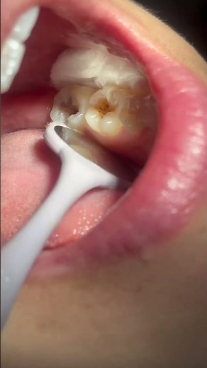 RESTAURAÇÃO EM RESINA COMPOSTA!