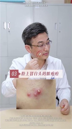 脸上不同位置长痘，都是什么原因？应该怎么处理？ #痘痘 #变美 #不同位置长痘痘的原因 #抖出健康知识宝藏 #我的年度健康盘点