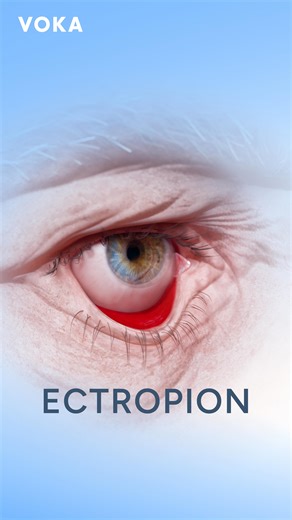 VOKA 3D Anatomy & Pathology | Ever heard of a condition where the eyelid turns outward? That’s called Ectropion👁️ Specifically, it’s a malposition of the lower eyelid... | Instagram