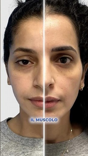 Come Correggere la Ptosi Palpebrale: Tecnica Chirurgica e Risultati